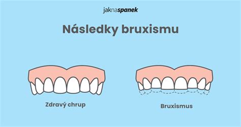 krlk skpe zubama|Bruxismus: skřípání zubů patří do rukou stomatologa。